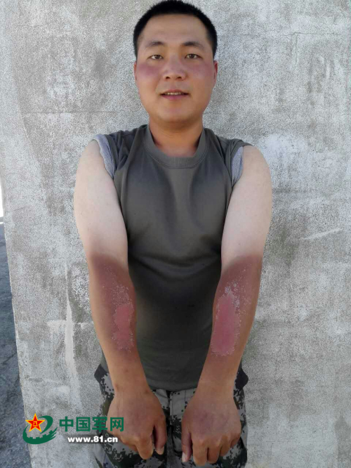 下士范鑫,人称"拼命三郎,几天下来,他的两只胳膊被严重晒伤,皮肤