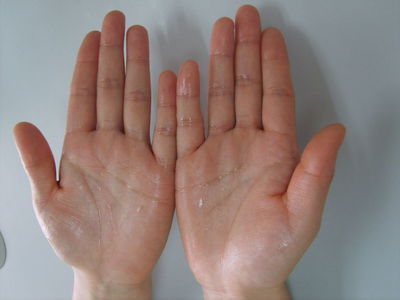 手心容易湿漉漉?原是手汗症作怪