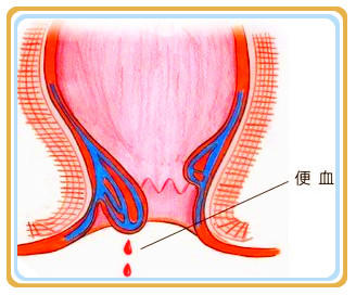 军医提醒:勿将所有便血当痔疮出血