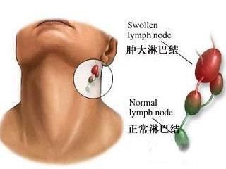 颈部囊性肿块,竟是甲状腺癌的转移灶