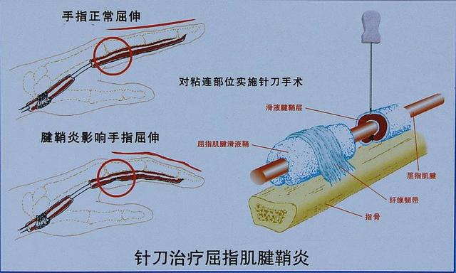 羊毛疗法什么原理_羊毛卷短发(3)