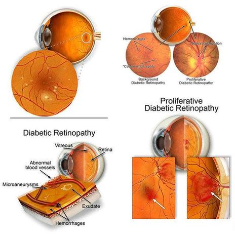 増殖糖尿病網膜症 (Eye Surgery Now illustrated)