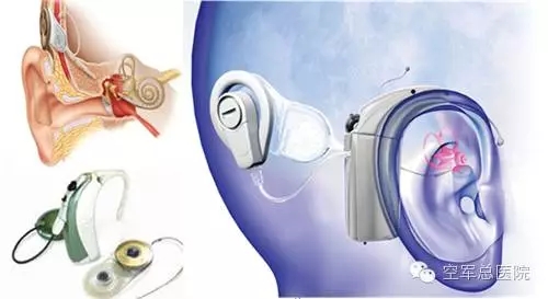 空军总医院耳鼻喉科首例人工耳蜗植入手术获成
