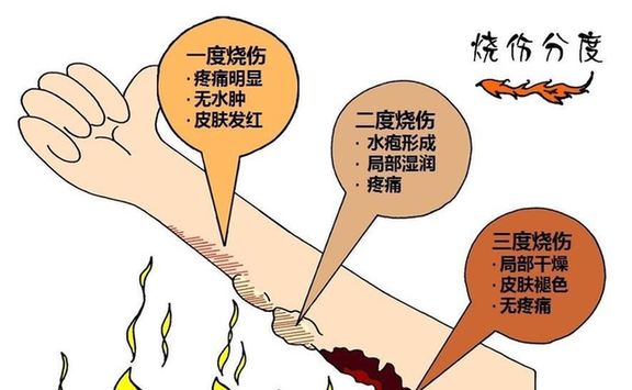 烫伤后摸盐是什么原理_二级烫伤是什么概念