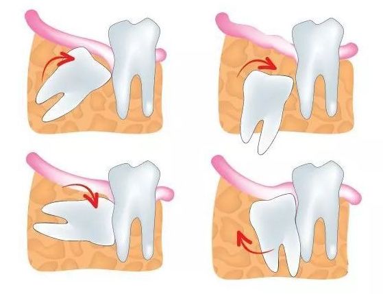 专家:阻生智齿应尽早拔除