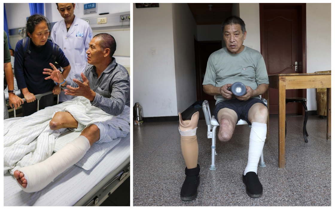 右图为2021年9月3日,姜水根在衢州江山市大陈乡大陈村家中脱下假肢