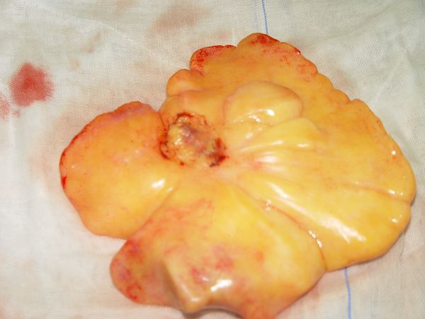 脂肪瘤内部图片