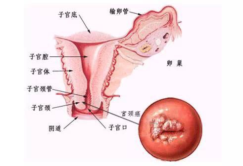 人乳头瘤女性症状图图片